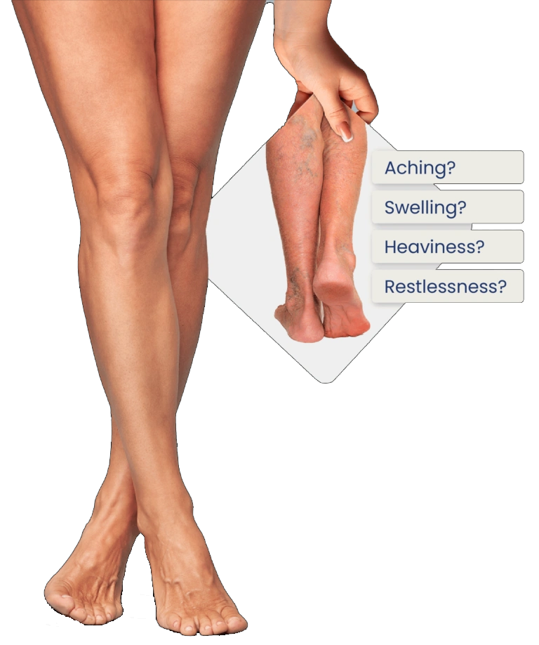 Legs showing varicose veins, illustrating symptoms like aching, swelling, heaviness, and restlessness treated by our vein care specialists